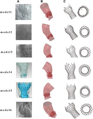 Computational study of transcatheter aortic valve replacement based on patient-specific models—rapid surgical planning for self-expanding valves